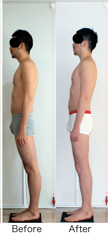 猫背とロルフィング