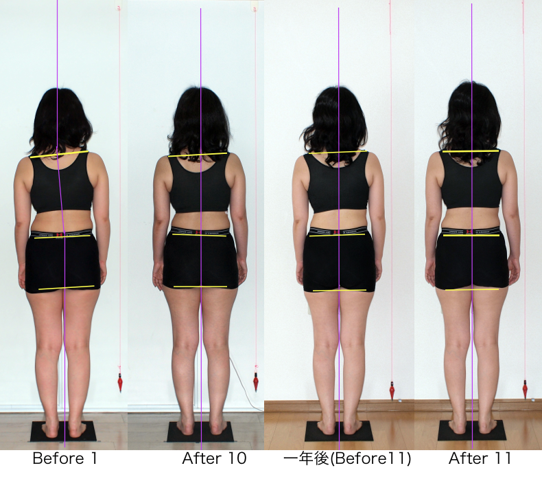 ロルフィングと脊柱側湾2